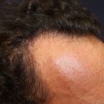 Hair Restoration Before & After Patient #5758