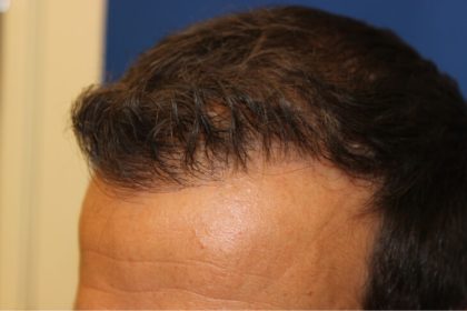 Hair Restoration Before & After Patient #6156
