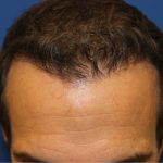 Hair Restoration Before & After Patient #6156