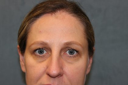 Blepharoplasty Before & After Patient #6221