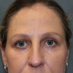 Blepharoplasty Before & After Patient #6221