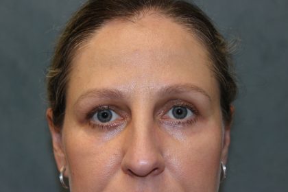 Blepharoplasty Before & After Patient #6221