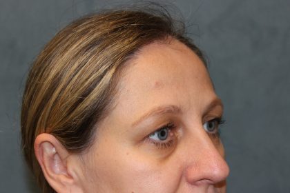 Blepharoplasty Before & After Patient #6221