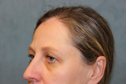 Blepharoplasty Before & After Patient #6221