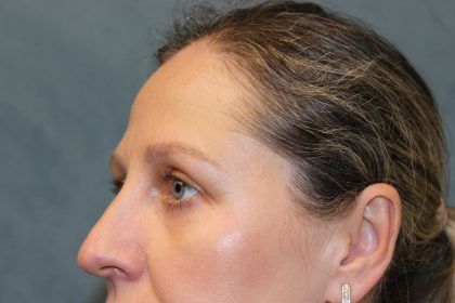 Blepharoplasty Before & After Patient #6221