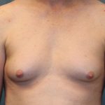 Transgender Top Surgery Before & After Patient #6220