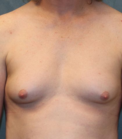 Transgender Top Surgery Before & After Patient #6220