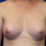 Transgender Top Surgery Before & After Patient #6220