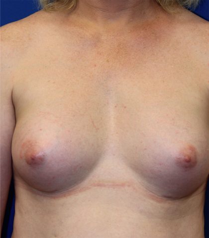 Transgender Top Surgery Before & After Patient #6220