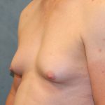 Transgender Top Surgery Before & After Patient #6220