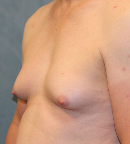 Transgender Top Surgery Before & After Patient #6220