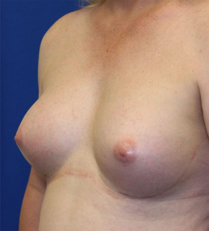 Transgender Top Surgery Before & After Patient #6220