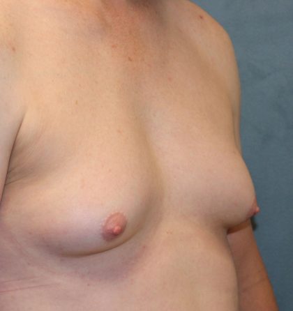 Transgender Top Surgery Before & After Patient #6220