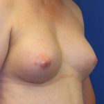 Transgender Top Surgery Before & After Patient #6220