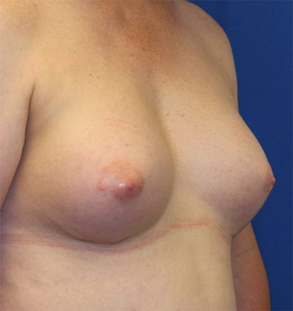 Transgender Top Surgery Before & After Patient #6220