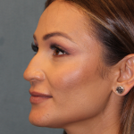 Rhinoplasty Before & After Patient #6229