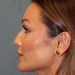 Rhinoplasty Before & After Patient #6229