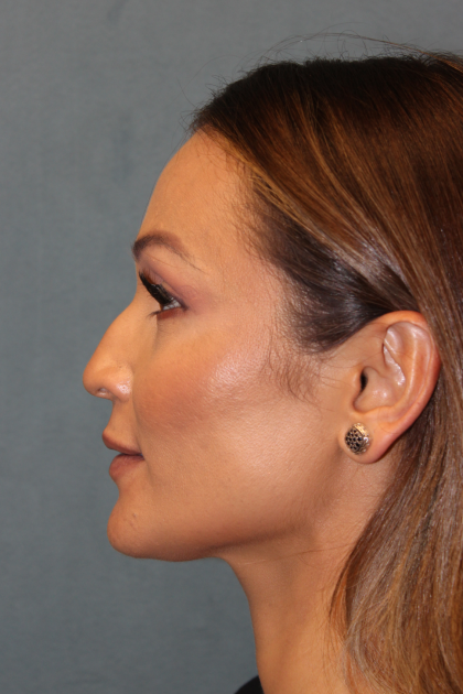 Rhinoplasty Before & After Patient #6229