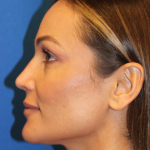 Rhinoplasty Before & After Patient #6229