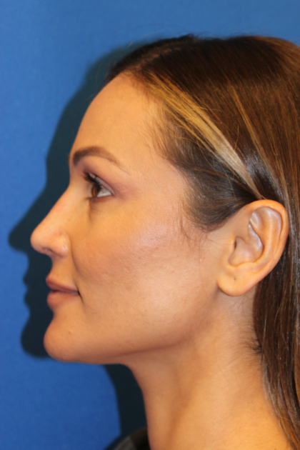 Rhinoplasty Before & After Patient #6229