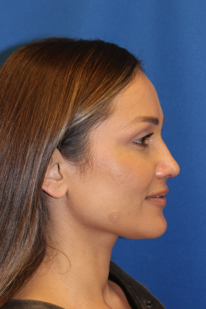 Rhinoplasty Before & After Patient #6229