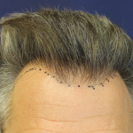 Hair Restoration Before & After Patient #6264