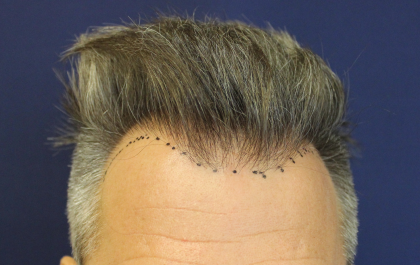 Hair Restoration Before & After Patient #6264