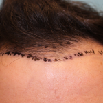 Hair Restoration Before & After Patient #6273