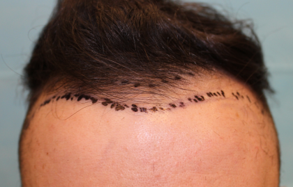 Hair Restoration Before & After Patient #6273