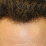 Hair Restoration Before & After Patient #6280