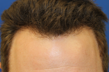 Hair Restoration Before & After Patient #6280