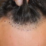 Hair Restoration Before & After Patient #6287