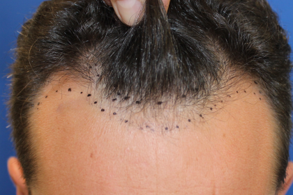 Hair Restoration Before & After Patient #6287