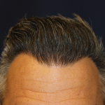 Hair Restoration Before & After Patient #6264