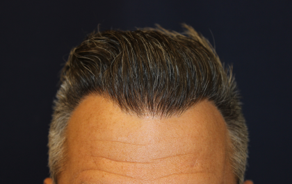 Hair Restoration Before & After Patient #6264