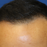 Hair Restoration Before & After Patient #6256