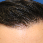 Hair Restoration Before & After Patient #6273