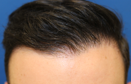 Hair Restoration Before & After Patient #6273