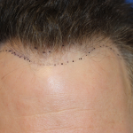 Hair Restoration Before & After Patient #6280