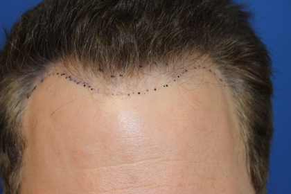 Hair Restoration Before & After Patient #6280