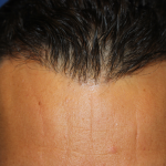 Hair Restoration Before & After Patient #6287