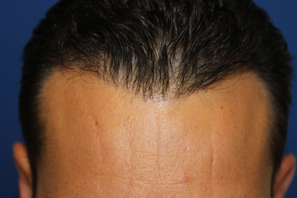 Hair Restoration Before & After Patient #6287