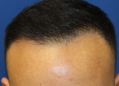 Hair Restoration Before & After Patient #6256