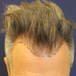 Hair Restoration Before & After Patient #6264