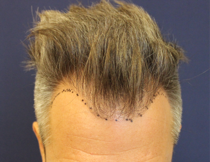 Hair Restoration Before & After Patient #6264