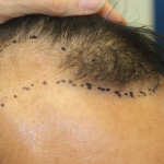 Hair Restoration Before & After Patient #6256