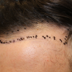 Hair Restoration Before & After Patient #6273