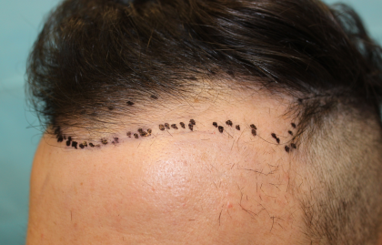 Hair Restoration Before & After Patient #6273