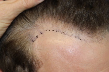 Hair Restoration Before & After Patient #6280