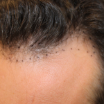 Hair Restoration Before & After Patient #6287